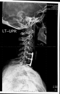 NECK PAIN XRAY