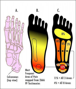 PLANTAR FASCIITIS