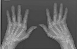 Rheumatoid Arthritis