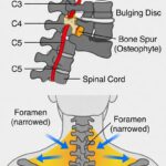 c4 subluxation
