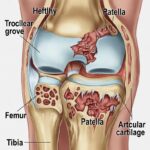 san leandro chiropracgtor chandromalacia patella